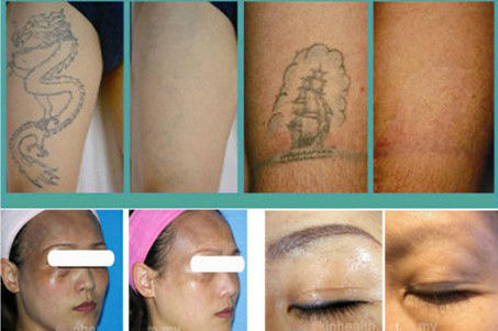 putih dan abu-abu laser Spot ukuran 2, 8mm Q beralih ND YAG Laser energi tato Remover